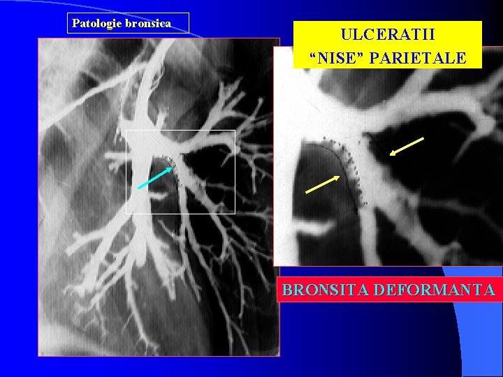 Patologie bronsica ULCERATII “NISE” PARIETALE BRONSITA DEFORMANTA 