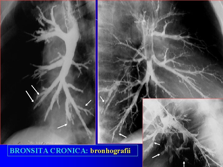 BRONSITA CRONICA: bronhografii 