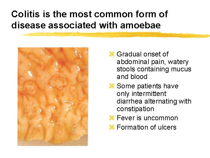 Colitis is the most common form of disease associated with amoebae z Gradual onset