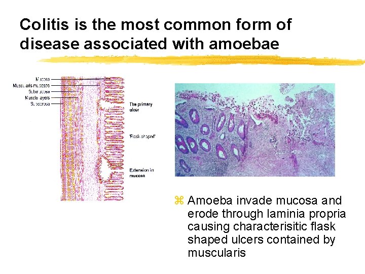 Colitis is the most common form of disease associated with amoebae z Amoeba invade