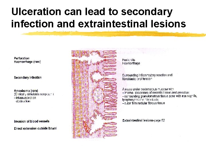 Ulceration can lead to secondary infection and extraintestinal lesions 