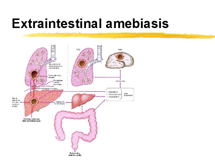Extraintestinal amebiasis 