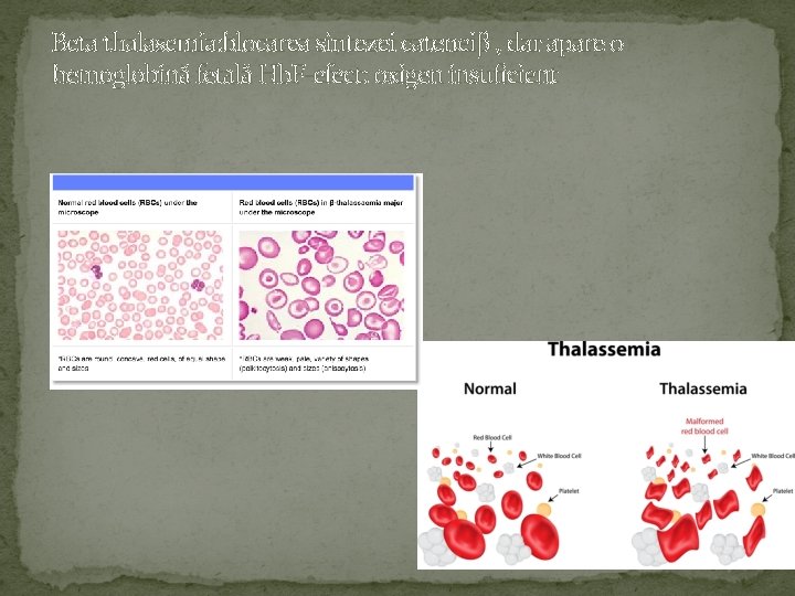 Beta thalasemia: blocarea sintezei cateneiβ , dar apare o hemoglobină fetală Hb. F-efect: oxigen