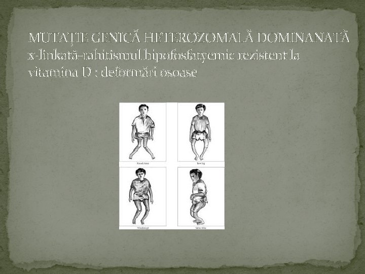 MUTAȚIE GENICĂ HETEROZOMALĂ DOMINANATĂ x-linkată-rahitismul hipofosfatyemic rezistent la vitamina D : deformări osoase 