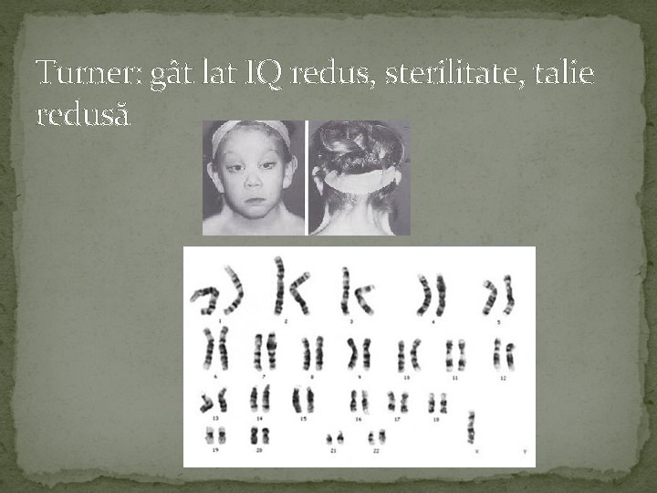 Turner: gât lat IQ redus, sterilitate, talie redusă 