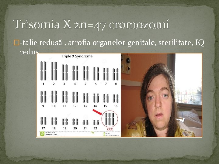 Trisomia X 2 n=47 cromozomi �-talie redusă , atrofia organelor genitale, sterilitate, IQ redus