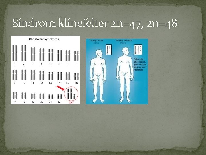 Sindrom klinefelter 2 n=47, 2 n=48 