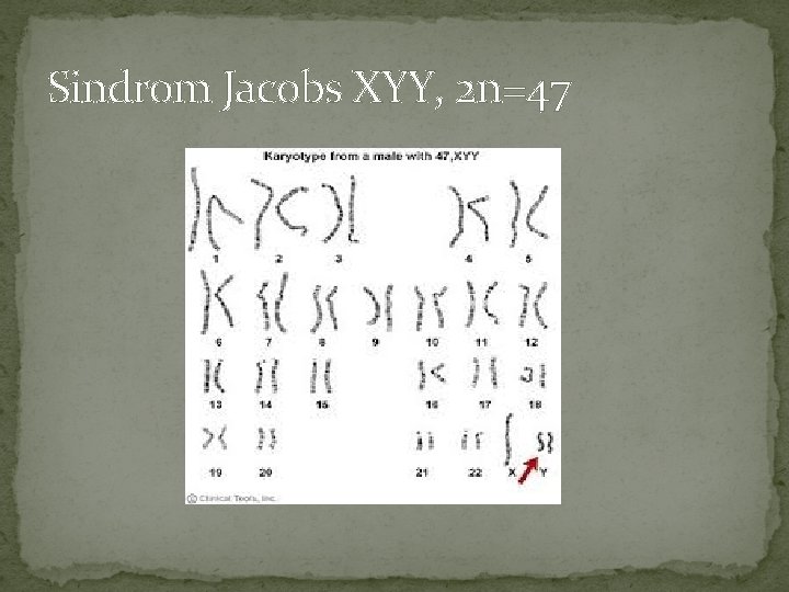 Sindrom Jacobs XYY, 2 n=47 