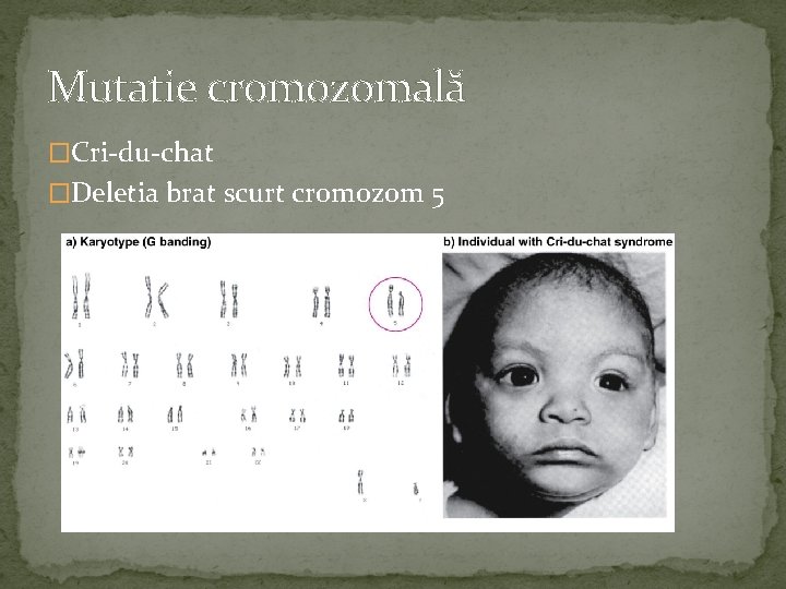 Mutatie cromozomală �Cri-du-chat �Deletia brat scurt cromozom 5 