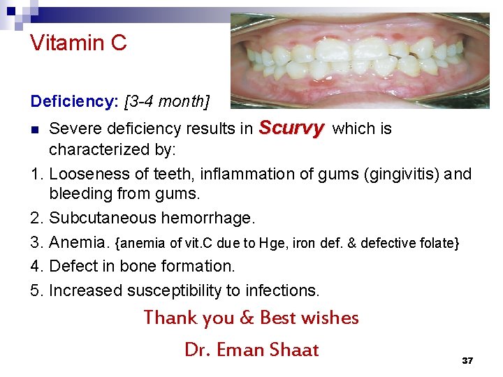 Vitamin C Deficiency: [3 -4 month] Severe deficiency results in Scurvy which is characterized