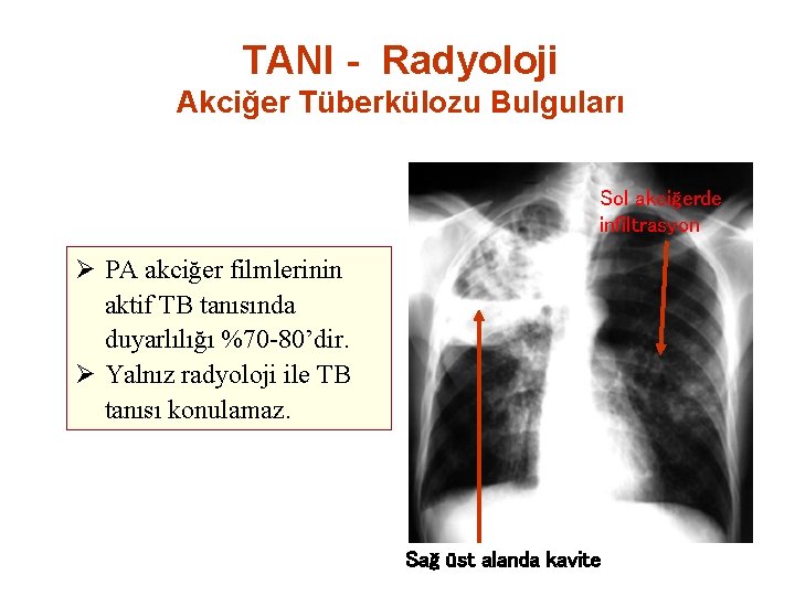 TANI - Radyoloji Akciğer Tüberkülozu Bulguları Sol akciğerde infiltrasyon Ø PA akciğer filmlerinin aktif