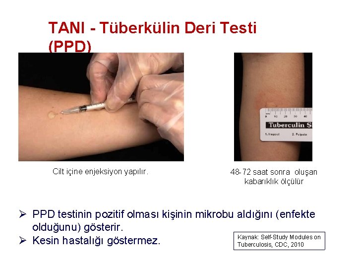TANI - Tüberkülin Deri Testi (PPD) Cilt içine enjeksiyon yapılır. 48 -72 saat sonra