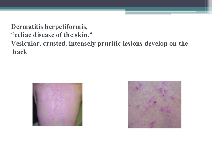 Dermatitis herpetiformis, “celiac disease of the skin. ” Vesicular, crusted, intensely pruritic lesions develop