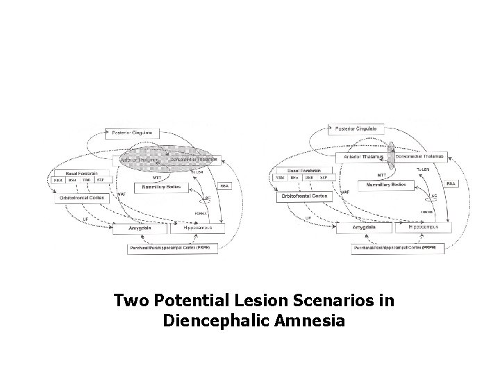 Two Potential Lesion Scenarios in Diencephalic Amnesia 
