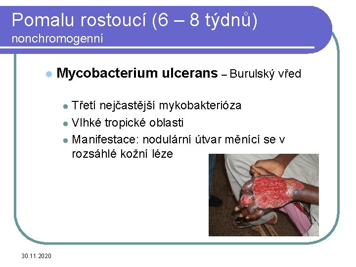 Pomalu rostoucí (6 – 8 týdnů) nonchromogenní l Mycobacterium ulcerans – Burulský vřed Třetí