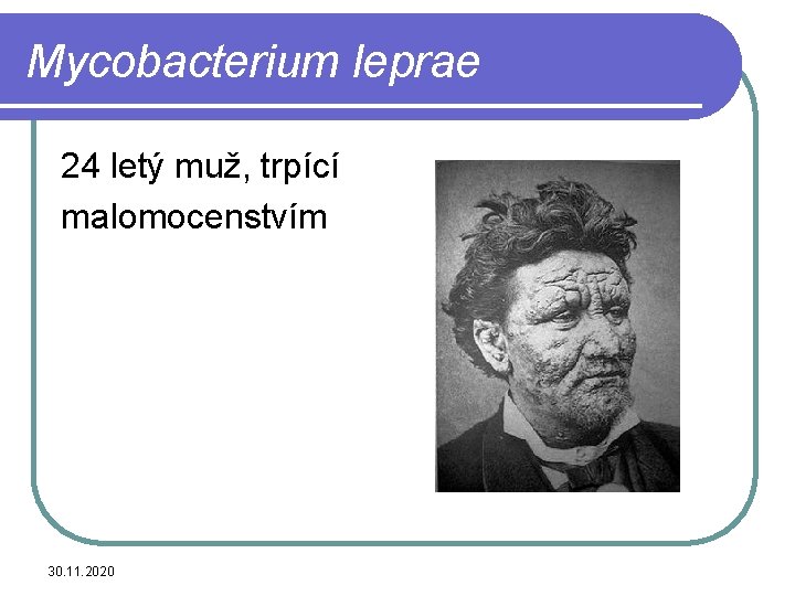 Mycobacterium leprae 24 letý muž, trpící malomocenstvím 30. 11. 2020 