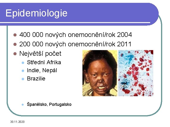 Epidemiologie 400 000 nových onemocnění/rok 2004 l 200 000 nových onemocnění/rok 2011 l Největší