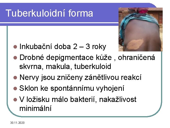 Tuberkuloidní forma l Inkubační doba 2 – 3 roky l Drobné depigmentace kůže ,