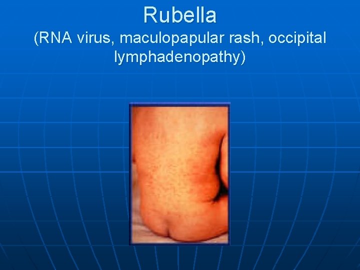 Rubella (RNA virus, maculopapular rash, occipital lymphadenopathy) 