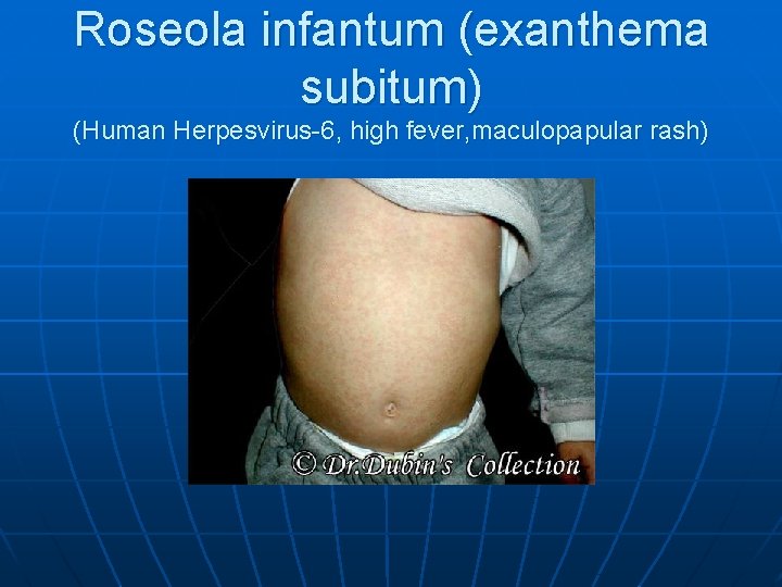 Roseola infantum (exanthema subitum) (Human Herpesvirus-6, high fever, maculopapular rash) 