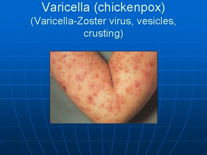 Varicella (chickenpox) (Varicella-Zoster virus, vesicles, crusting) 