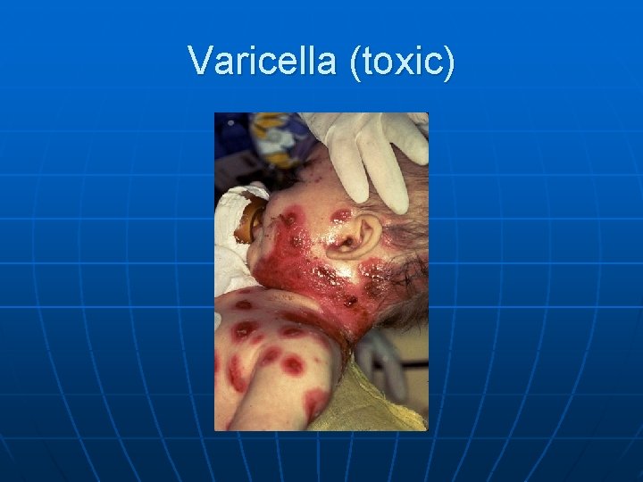 Varicella (toxic) 