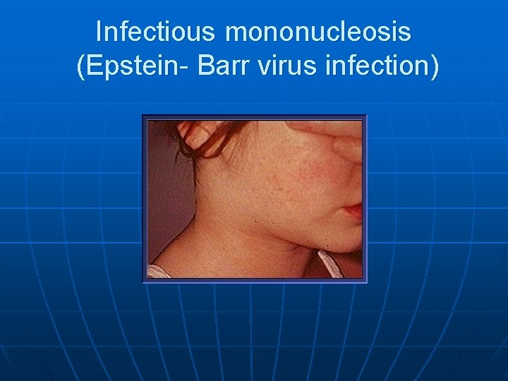 Infectious mononucleosis (Epstein- Barr virus infection) 