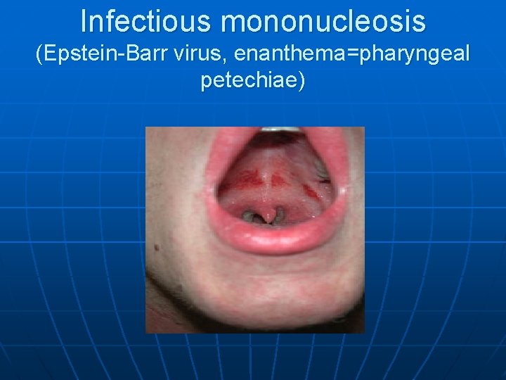 Infectious mononucleosis (Epstein-Barr virus, enanthema=pharyngeal petechiae) 
