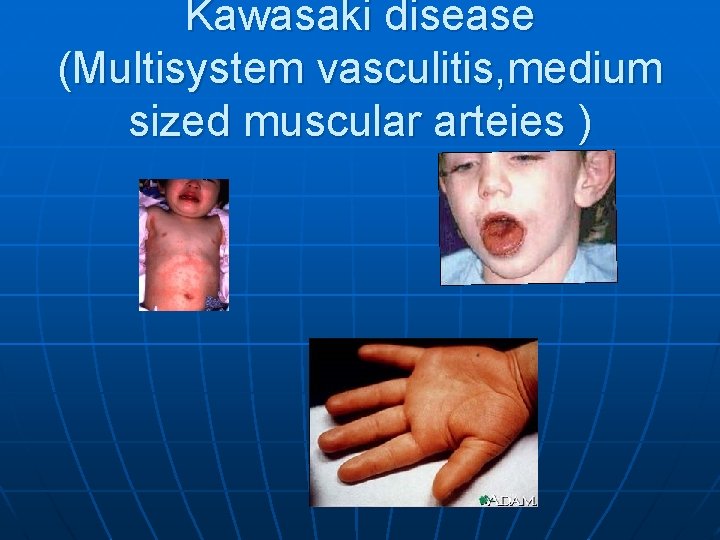 Kawasaki disease (Multisystem vasculitis, medium sized muscular arteies ) 