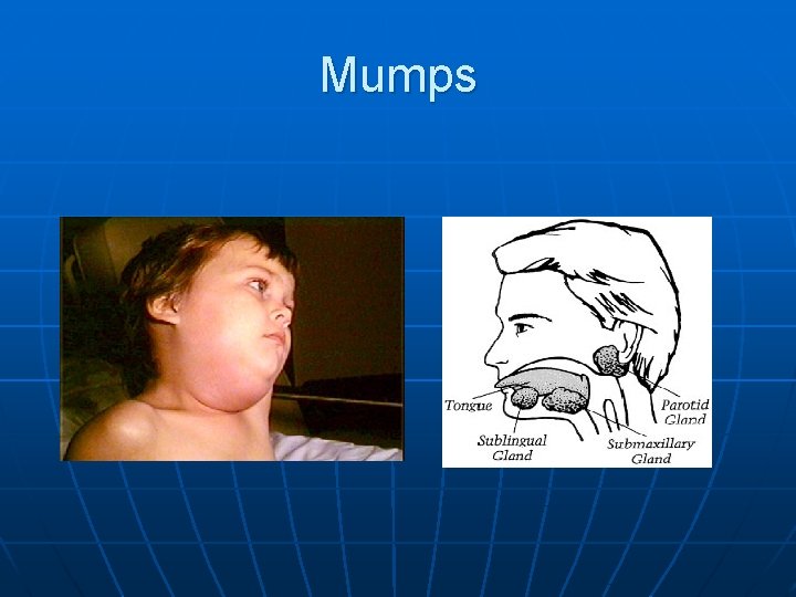 Mumps 