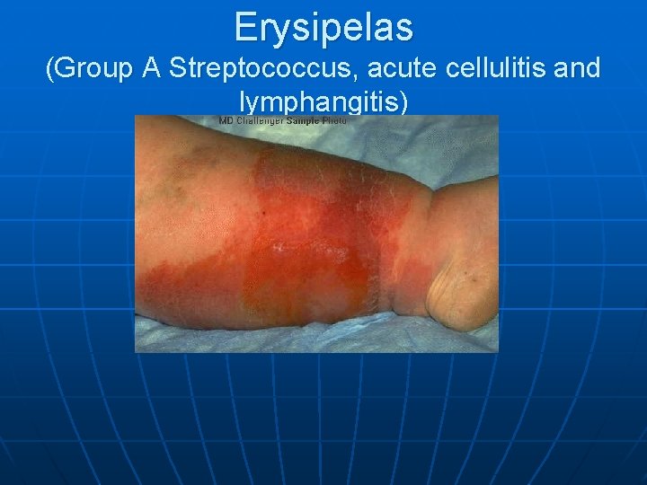 Erysipelas (Group A Streptococcus, acute cellulitis and lymphangitis) 