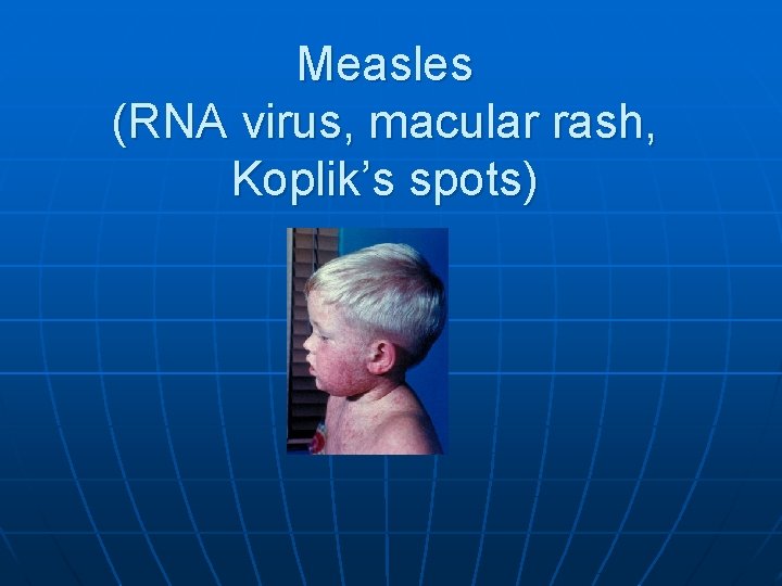 Measles (RNA virus, macular rash, Koplik’s spots) 