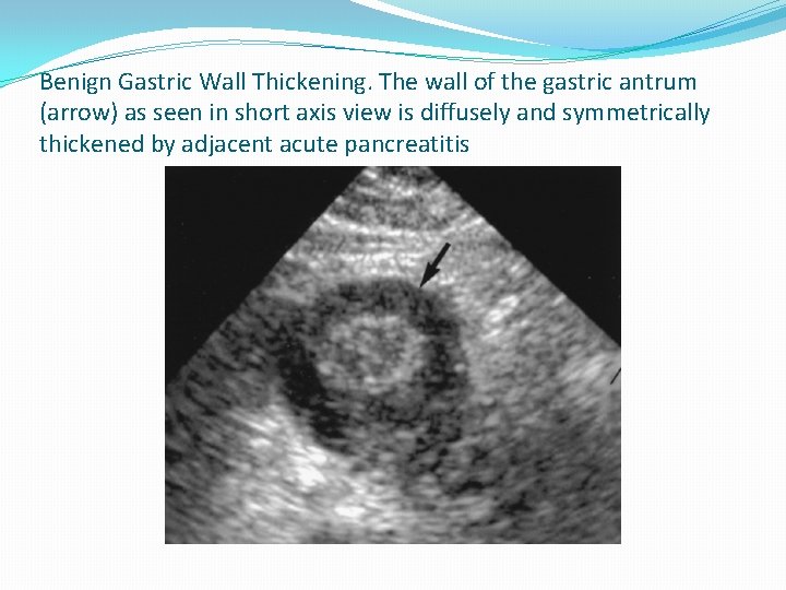 Benign Gastric Wall Thickening. The wall of the gastric antrum (arrow) as seen in Benign Gastric Wall Thickening. The wall of the gastric antrum (arrow) as seen in