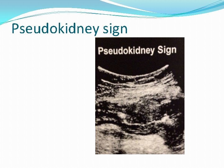 Pseudokidney sign Pseudokidney sign