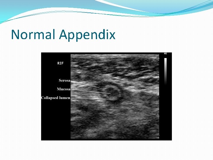 Normal Appendix Normal Appendix