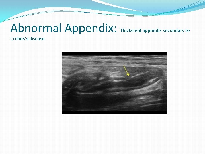 Abnormal Appendix: Crohns’s disease. Thickened appendix secondary to Abnormal Appendix: Crohns’s disease. Thickened appendix secondary to