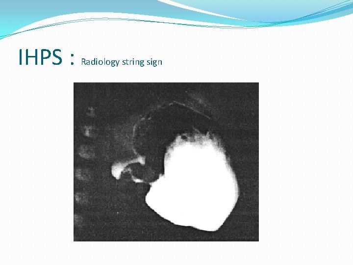 IHPS : Radiology string sign IHPS : Radiology string sign