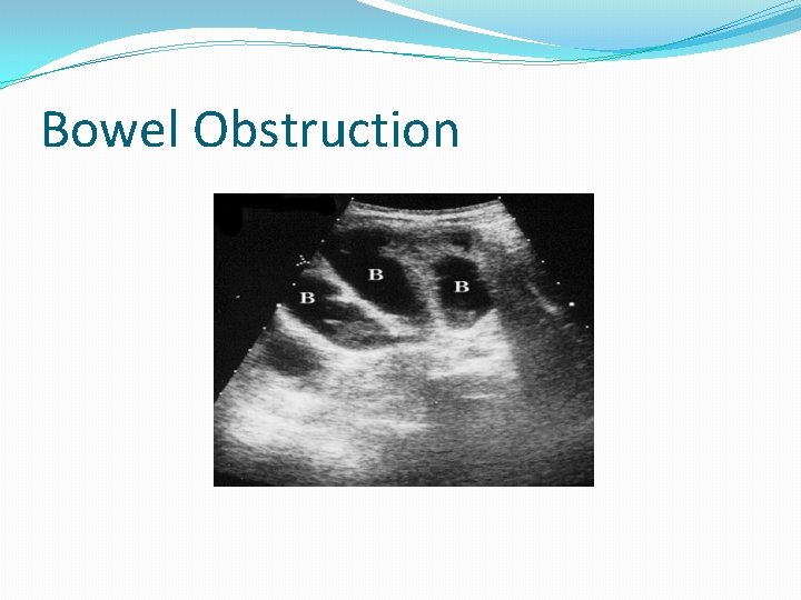 Bowel Obstruction Bowel Obstruction