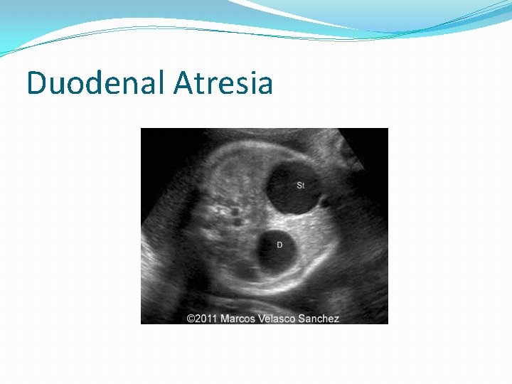 Duodenal Atresia Duodenal Atresia