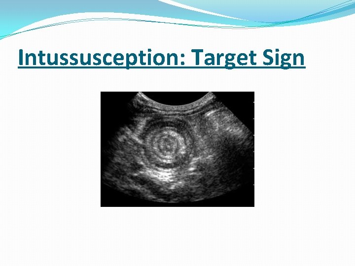 Intussusception: Target Sign Intussusception: Target Sign