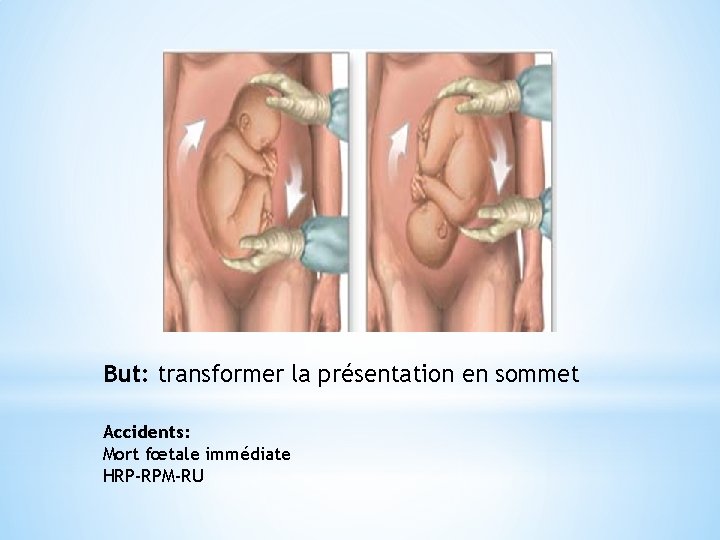 But: transformer la présentation en sommet Accidents: Mort fœtale immédiate HRP-RPM-RU 