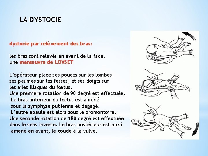 LA DYSTOCIE dystocie par relèvement des bras: les bras sont relevés en avant de