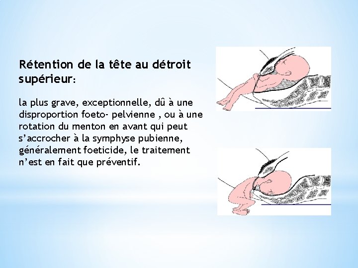 Rétention de la tête au détroit supérieur: la plus grave, exceptionnelle, dû à une