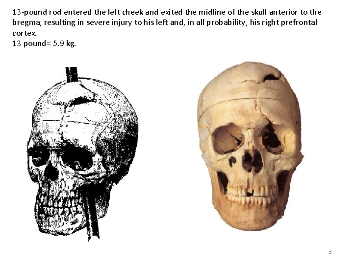 13 -pound rod entered the left cheek and exited the midline of the skull