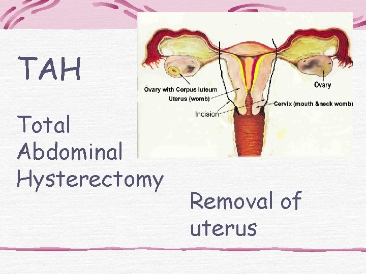TAH Total Abdominal Hysterectomy Removal of uterus 