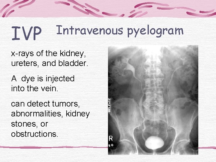 IVP Intravenous pyelogram x-rays of the kidney, ureters, and bladder. A dye is injected