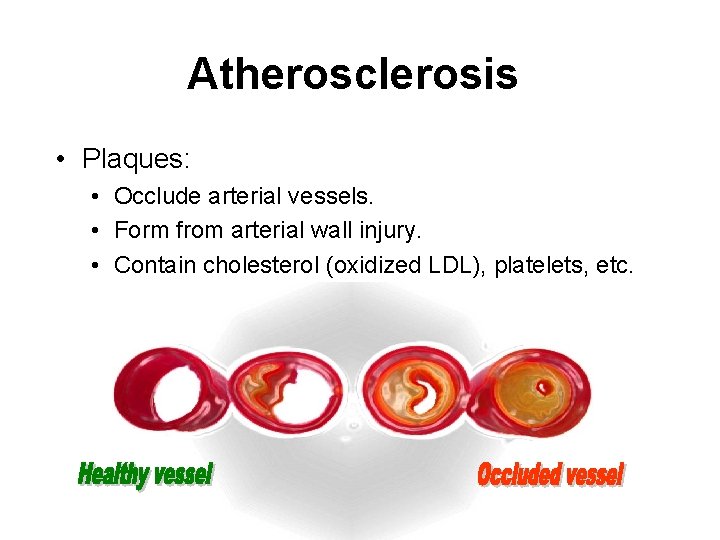 Atherosclerosis • Plaques: • Occlude arterial vessels. • Form from arterial wall injury. •