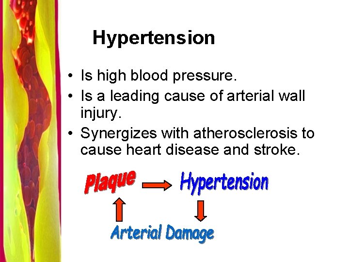 Hypertension • Is high blood pressure. • Is a leading cause of arterial wall