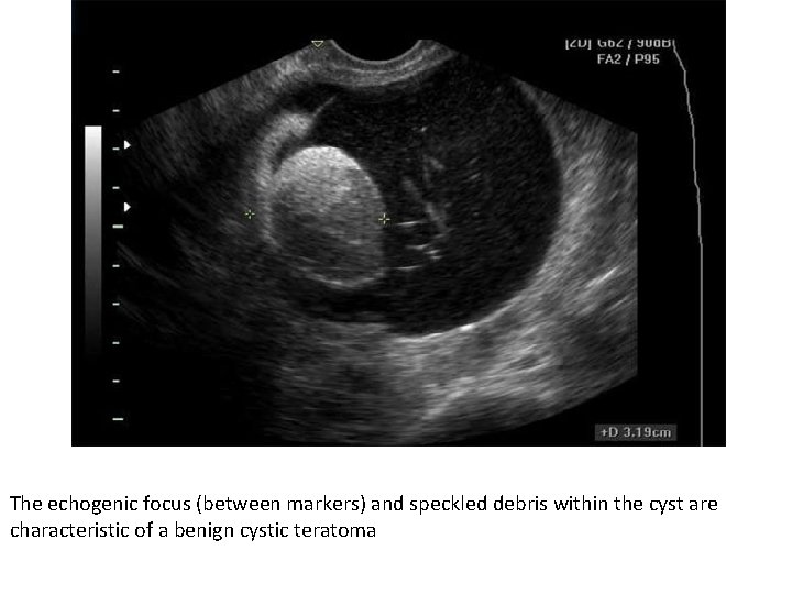 The echogenic focus (between markers) and speckled debris within the cyst are characteristic of