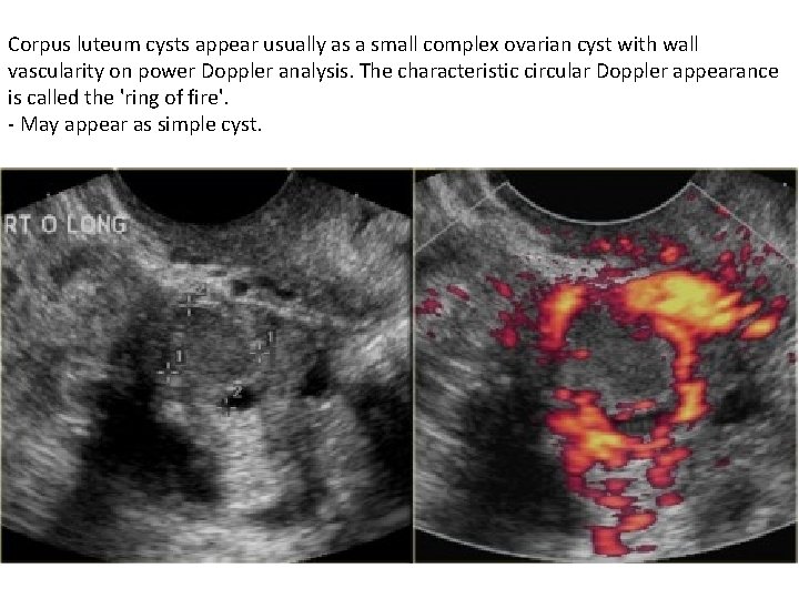 Corpus luteum cysts appear usually as a small complex ovarian cyst with wall vascularity